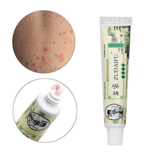 Dropshipping Zudaifu Skin Psoriasis Cream Dermatitis Eczematoid Eczema Ointment Treatment Psoriasis Cream Skin Care Cream